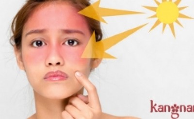 Điều trị da cháy nắng đơn giản bằng nguyên liệu thiên nhiên ngay tại nhà