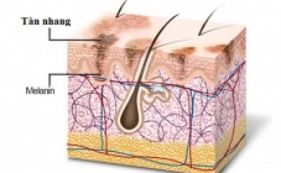 Cách trị tàn nhang trên da mặt tại nhà hiệu quả nhất.