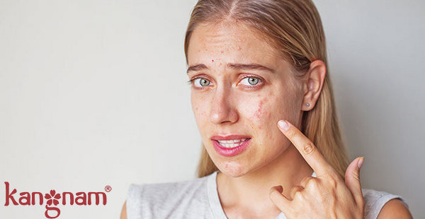 Nhiều người đang phải đối mặt với mụn như một căn bệnh về da