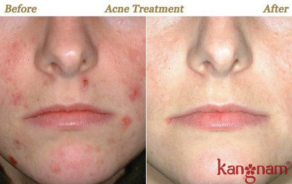 Trải nghiệm Blemish Spot Treatment của khách hàng