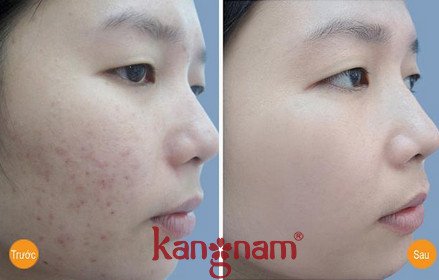 kem trị mụn hiệu quả 07