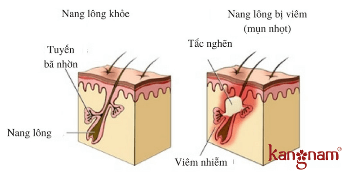 phương pháp trị mụn hệu quả 01