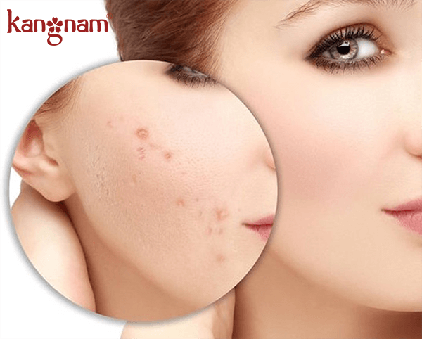 sản phẩm trị thâm mụn 01