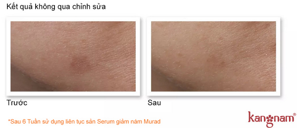 "Tiết lộ" lý do Serum giảm nám Murad lại được nhiều người tin tưởng