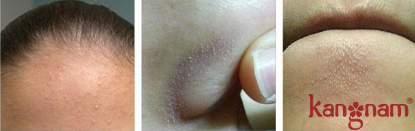 Mụn cám thường mọc nhiều tại trán, cằm và mũi