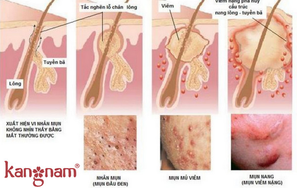 cách trị mụn trứng cá